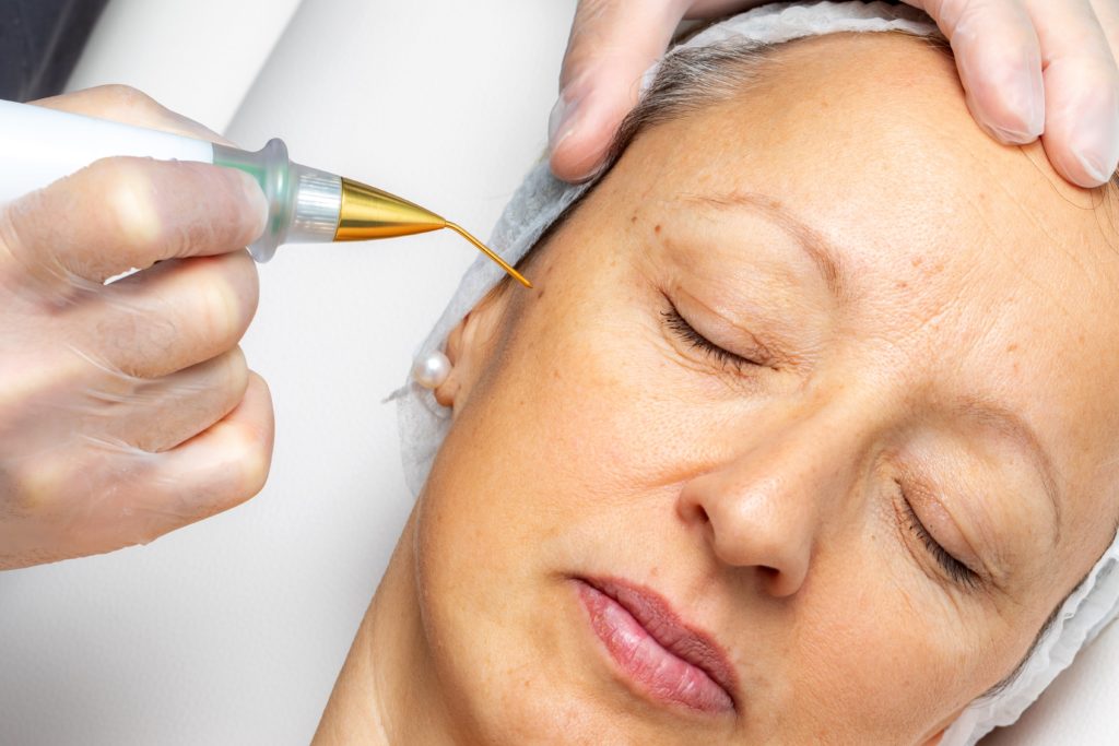 What is a Skin pen, and What is the treatment experience like? 1 Arabella Medical Aesthetics What is a Skin pen and What is the treatment experience like