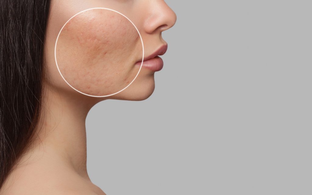Woman having Acne scars and redness on her cheeks | Lutronic Ultra Laser at Arabella Medical Aesthetics in Knoxville, TN