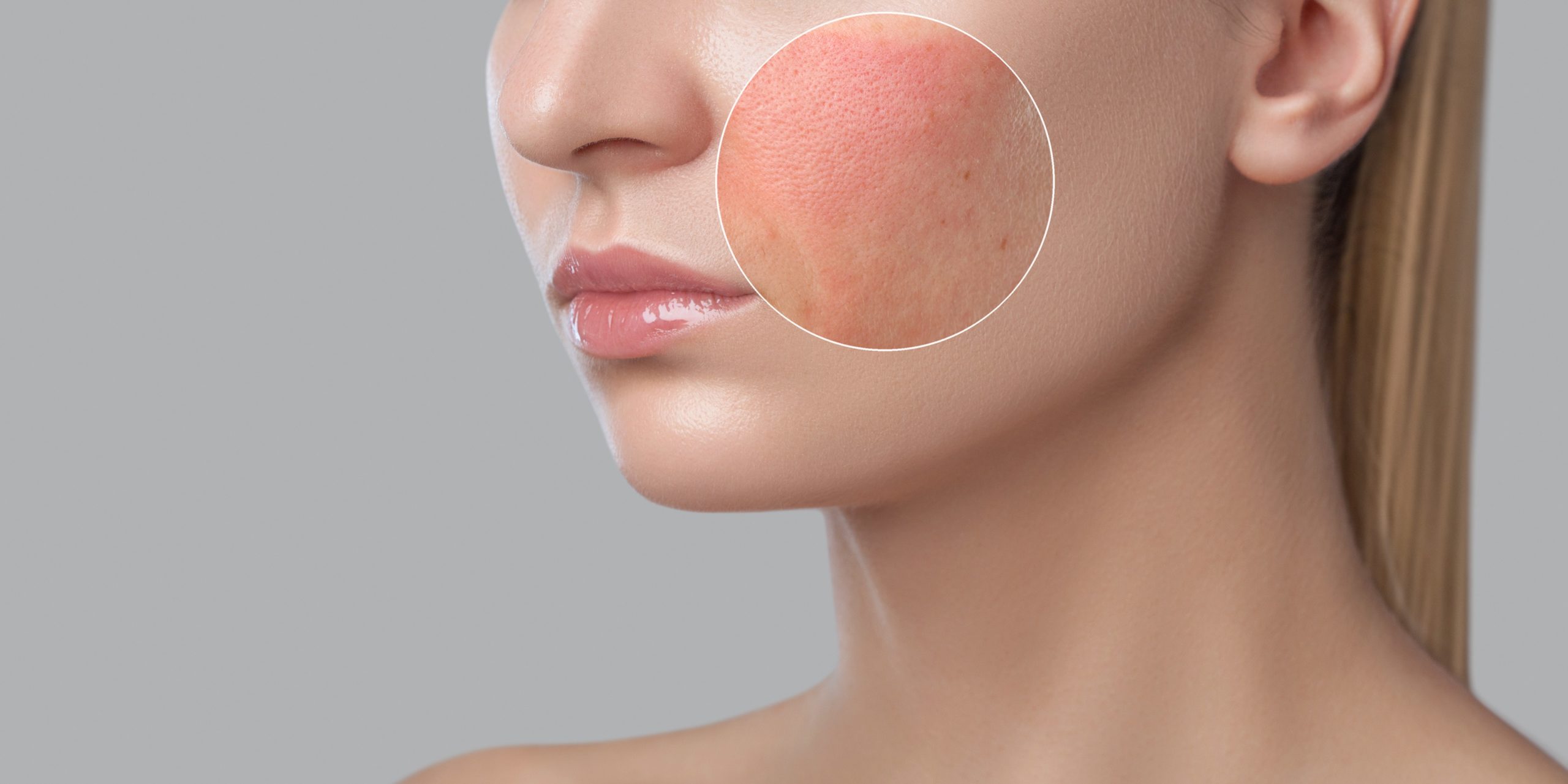 Woman having Rashes on her cheeks | Lutronic Ultra Laser at Arabella Medical Aesthetics in Knoxville, TN