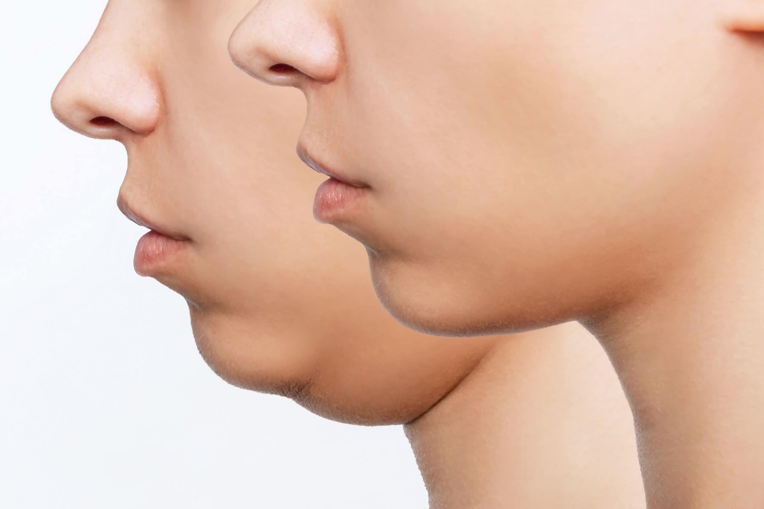 Blogs 1 Kybella-By-Arabella-Medical-Aesthetics-in- Knoxville-TN