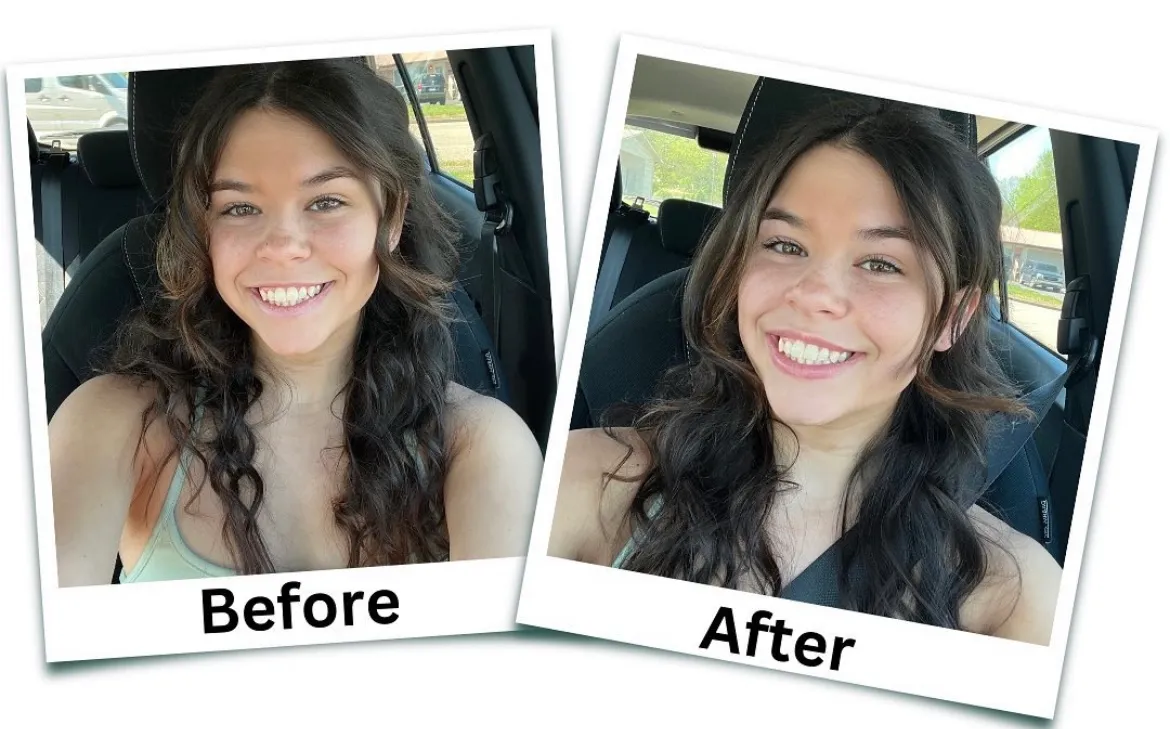 Lip Flip | Before and After Transformation Photo of Girl | Arabella Medical Aesthetics | Knoxville, TX