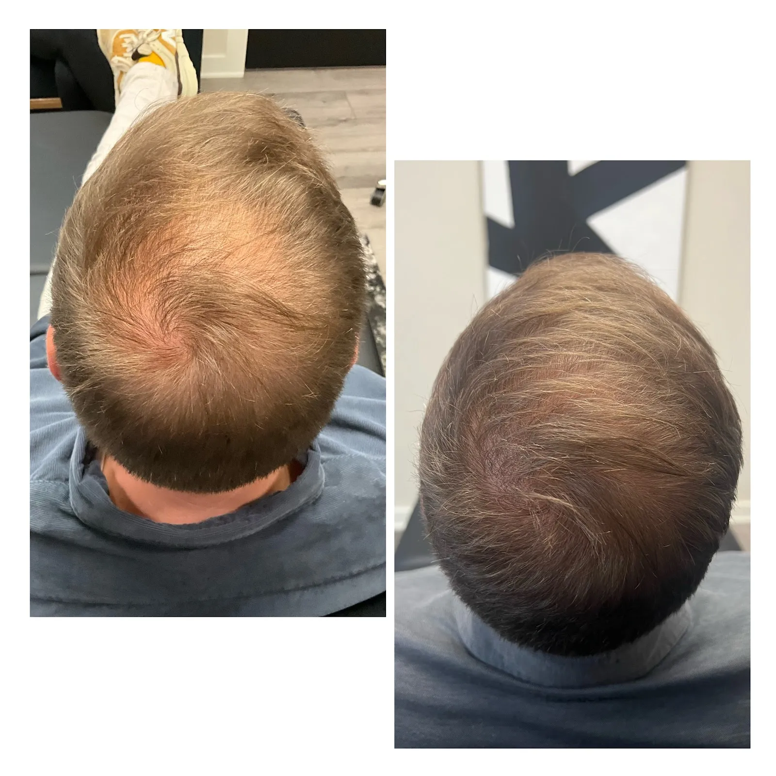 Laser Hair Restoration for Hair Loss Treatment | Arabella Medical Aesthetics | Knoxville, TX