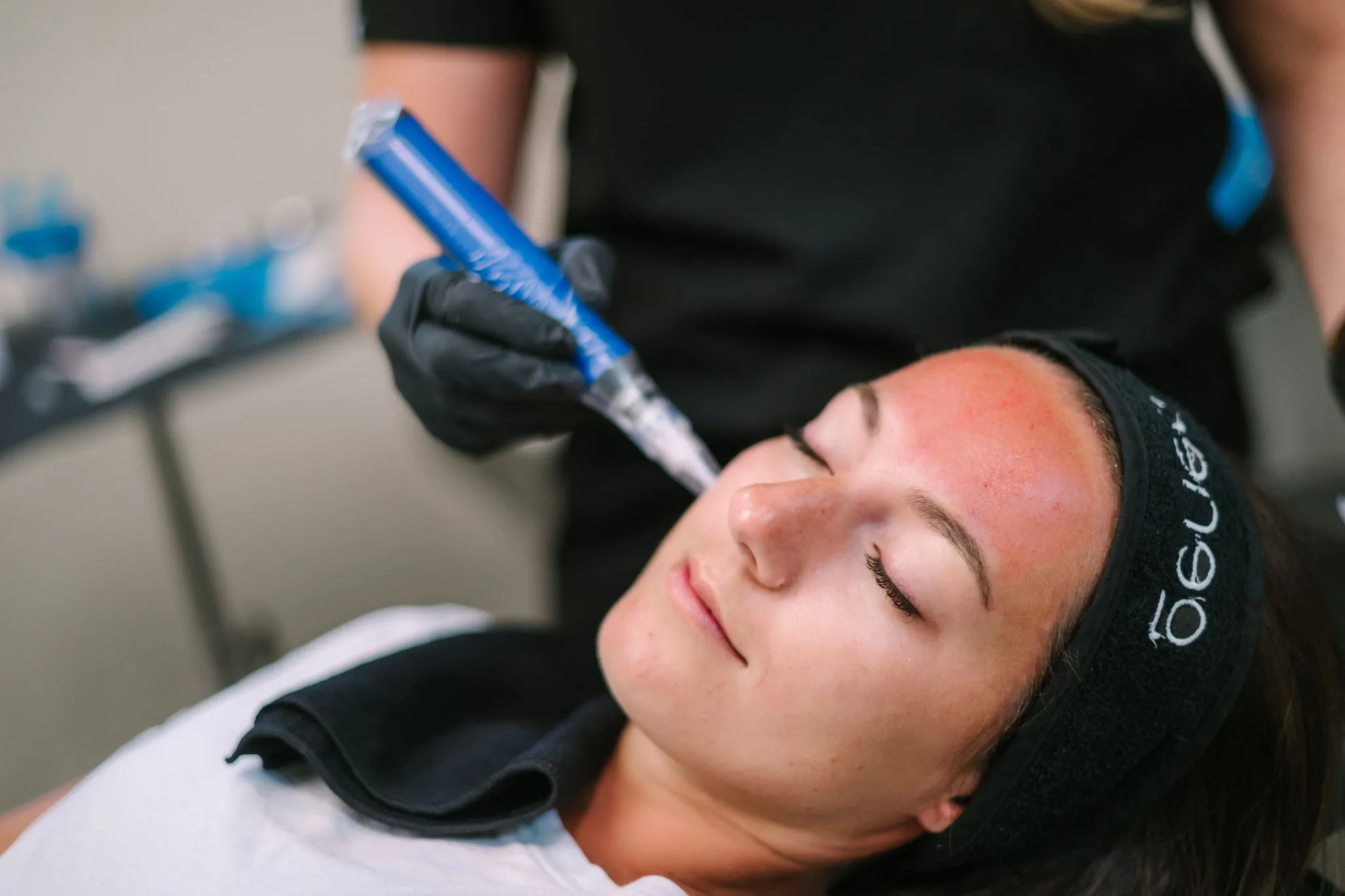 Microneedling Equipment used for treatment | Arabella Medical Aesthetics | Knoxville, TX