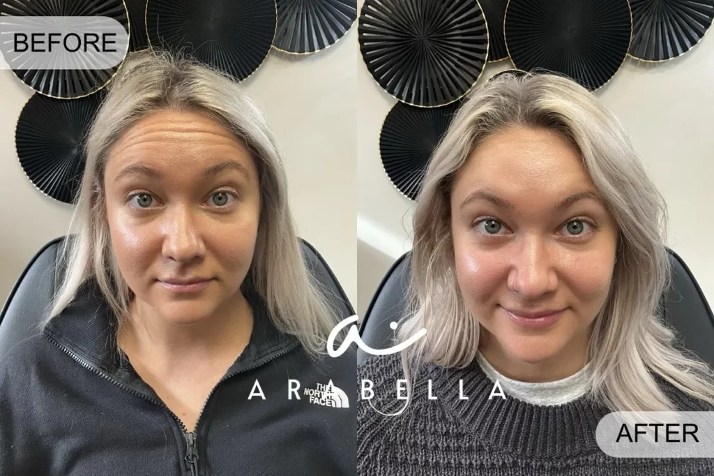 Botox for forehead lines | Before and After Photo | Arabella Medical Aesthetics | Knoxville, TX