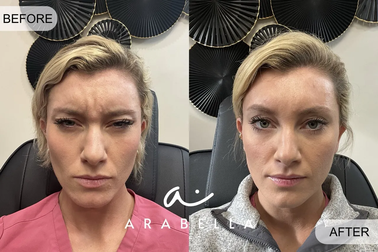 Botox Before and After Photo of Patient 4 | Arabella Medical Aesthetics | Knoxville, TX