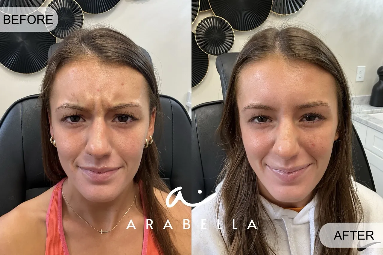 Botox Before and After Photo of Patient 3 | Arabella Medical Aesthetics | Knoxville, TX