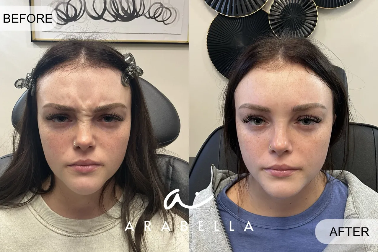 Before and After Photo | Botox Treatment at Arabella Medical Aesthetics | Knoxville, TX