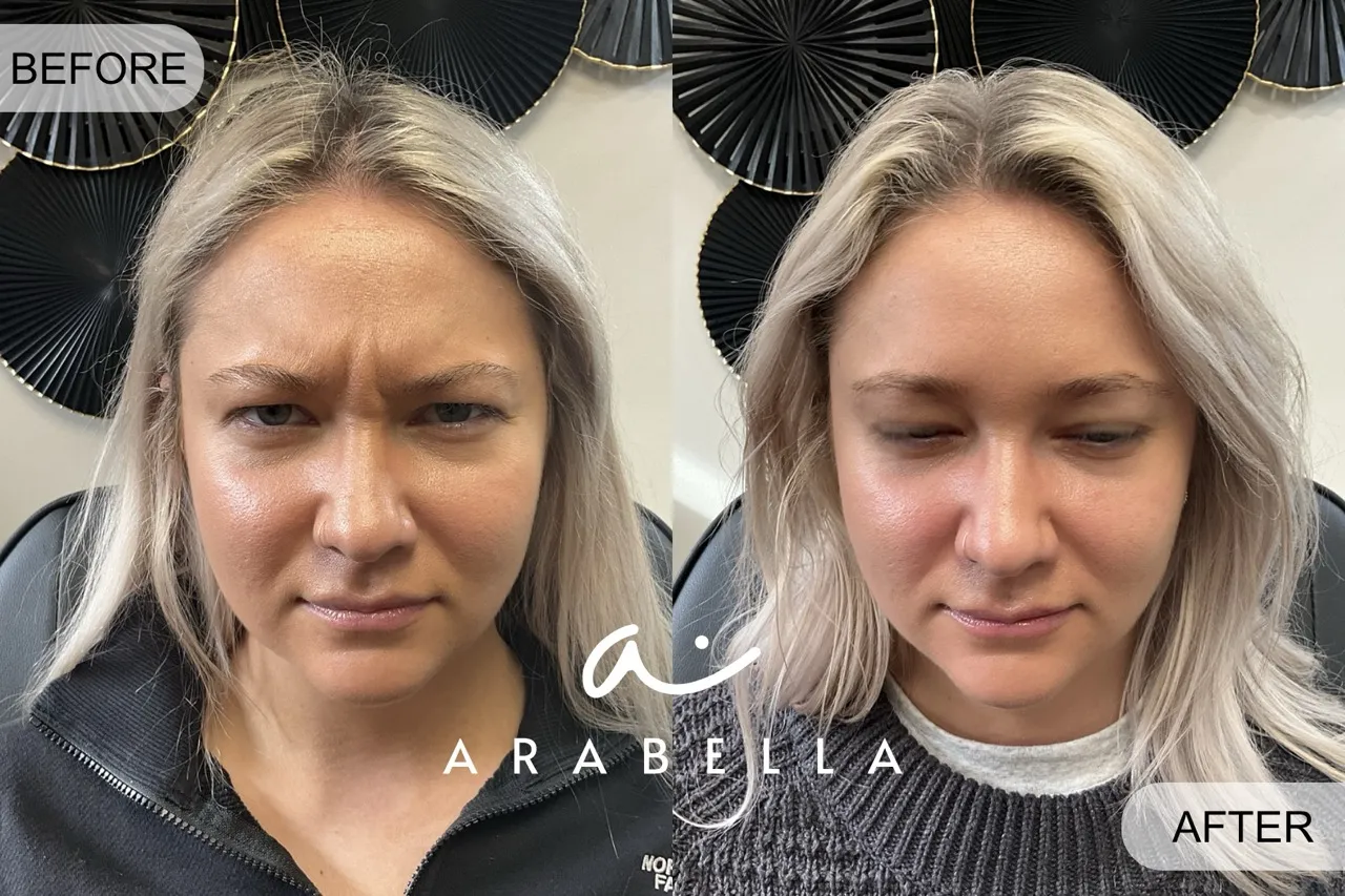 Botox Treatment for frown lines | Before and After Photo | Arabella Medical Aesthetics | Knoxville, TX