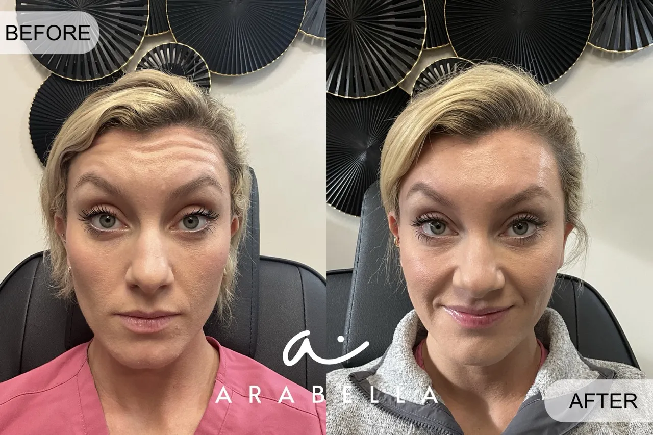 Botox Treatment of Patient 4 | Before and After Photo | Arabella Medical Aesthetics | Knoxville, TX