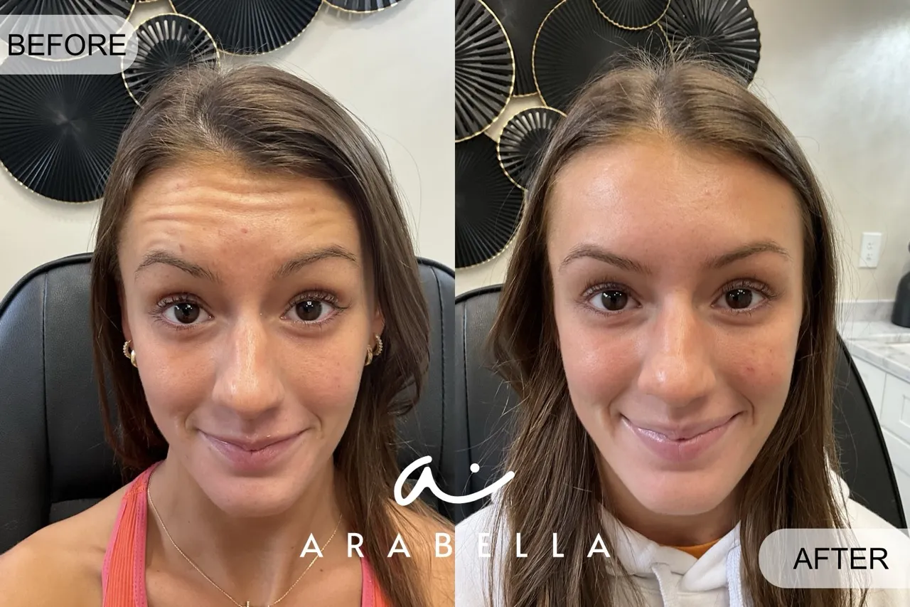 Botox Before and After Treatment Photo | Arabella Medical Aesthetics | Knoxville, TX