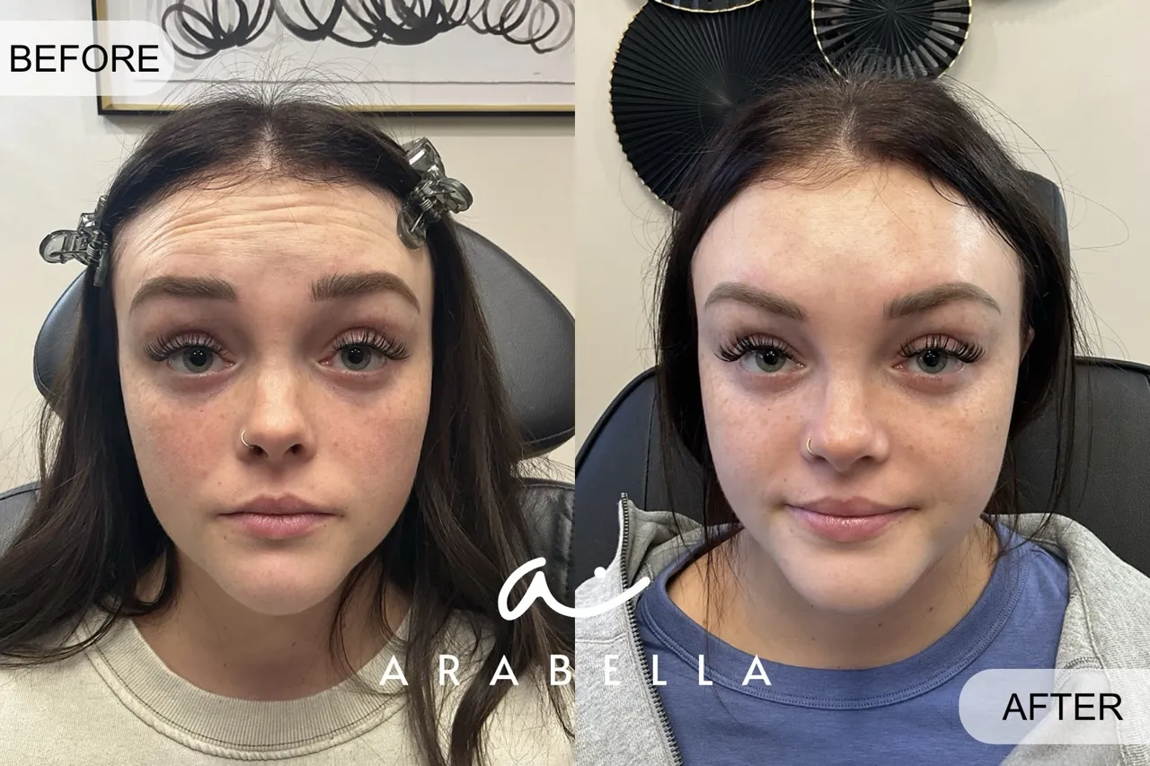 Before and After Photo of Patient 2| Botox Treatment at Arabella Medical Aesthetics | Knoxville, TX