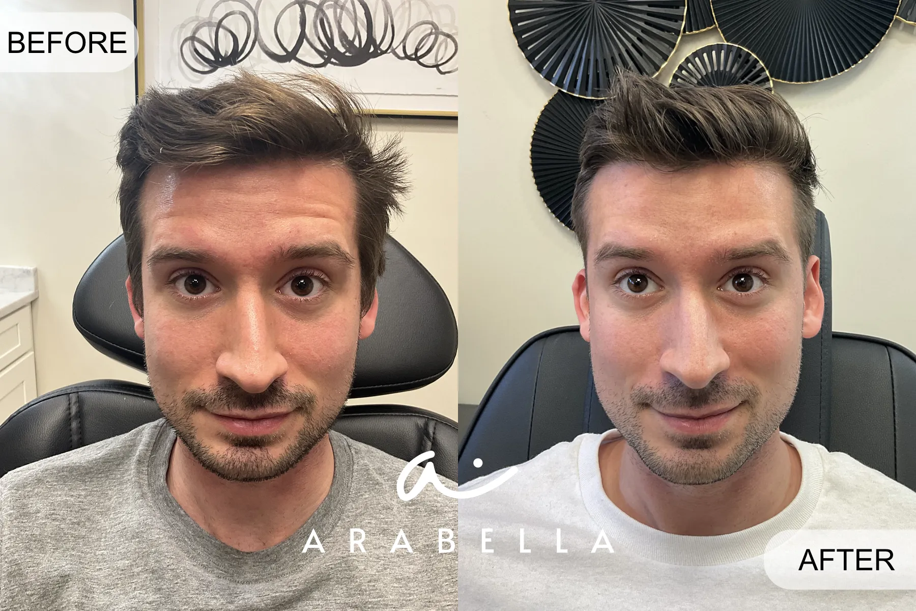 Botox | Before and After Photo of Patient | Arabella Medical Aesthetics | Knoxville, TX