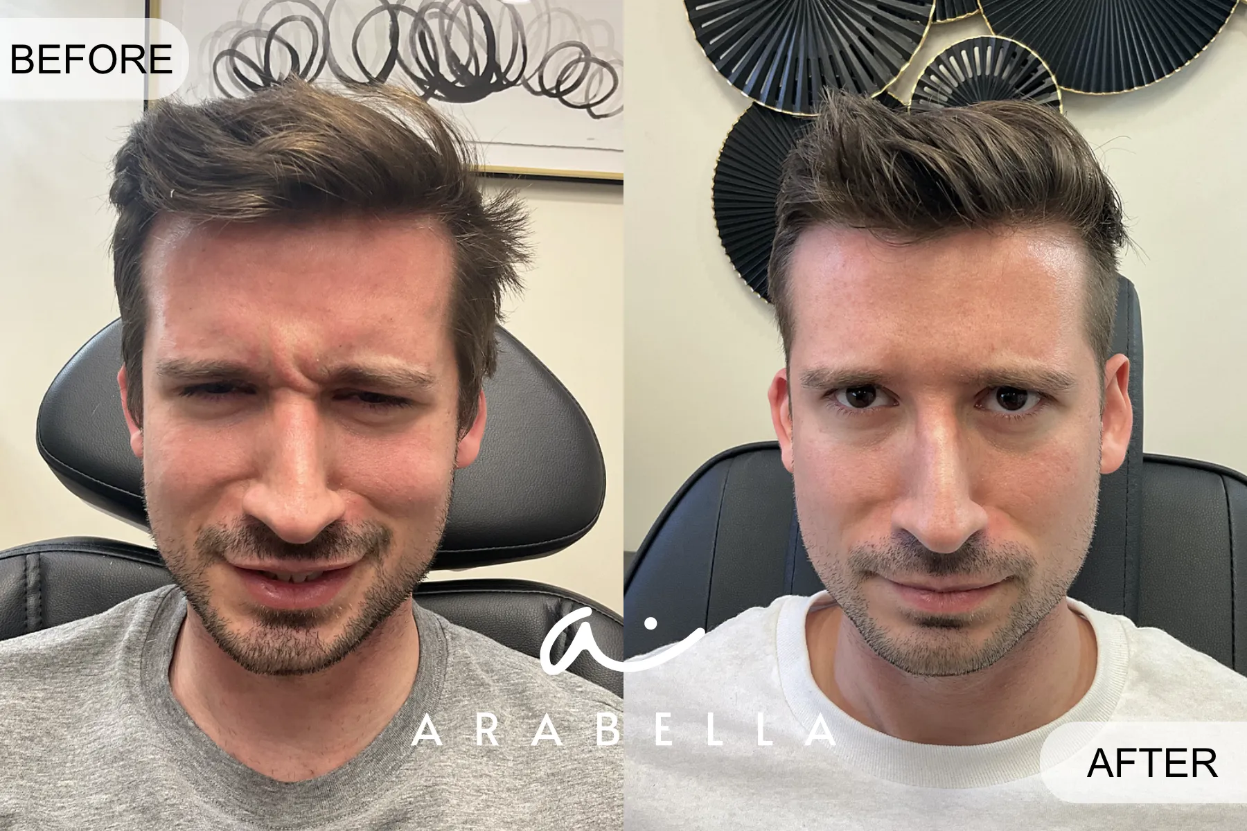 Botox | Make Patient | Before and After Photo | Arabella Medical Aesthetics | Knoxville, TX