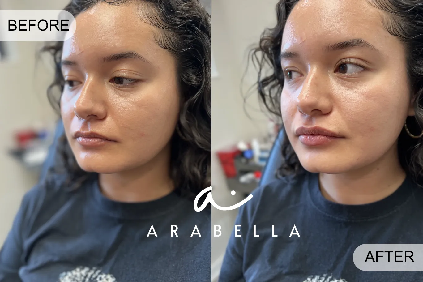 Lip Filler | Patient Side Profile | Before and After Photo | Arabella Medical Aesthetics | Knoxville, TX