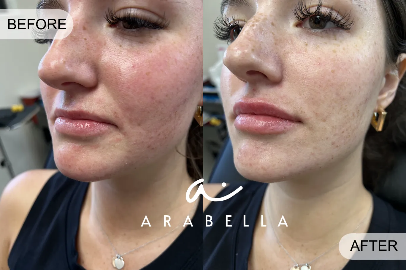 Lip Filler | Before and After Photo of Patient 6 | Arabella Medical Aesthetics | Knoxville, TX