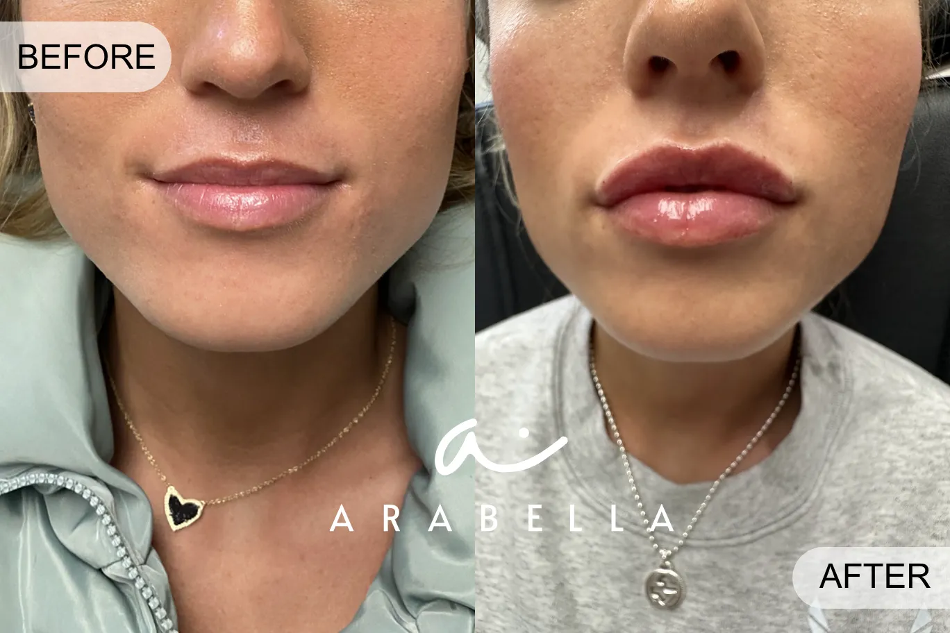 Lip Filler | Before and After Photo of Patient | Arabella Medical Aesthetics | Knoxville, TX