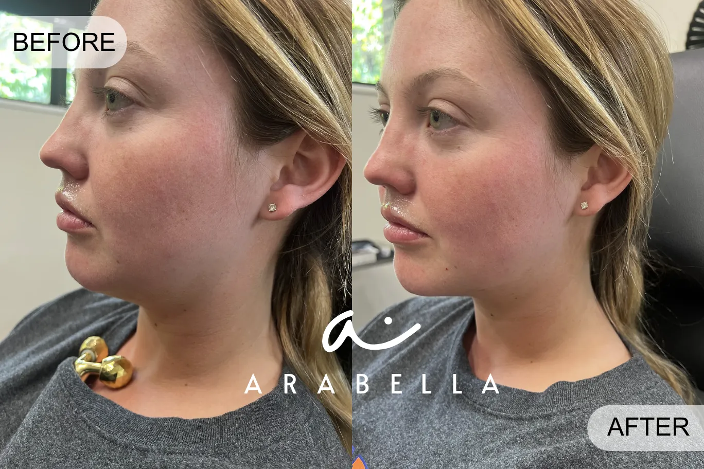 Lip Filler | Patient 5 | Before and After Photo | Arabella Medical Aesthetics | Knoxville, TX