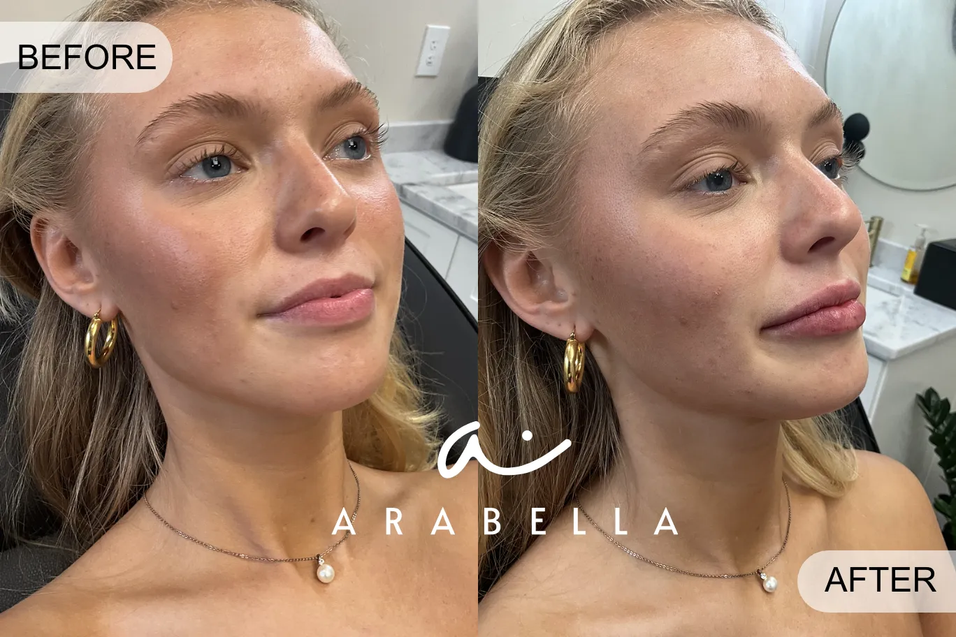 Woman Lip Filler Treatment | Before and After Photo | Arabella Medical Aesthetics | Knoxville, TX