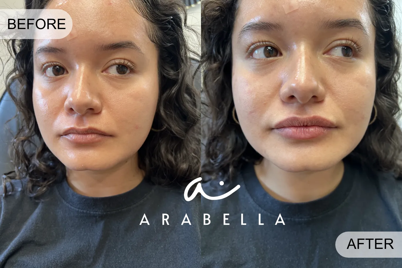 Lip Filler | Before and After Photo | Arabella Medical Aesthetics | Knoxville, TX