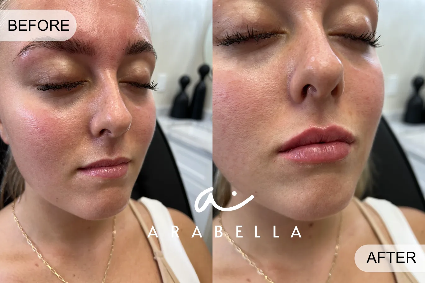 Lip Filler | Close up of Before and After Photo | Arabella Medical Aesthetics | Knoxville, TX