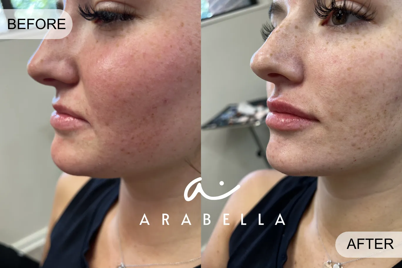 Lip Filler | Patient 6 | Before and After Photo | Arabella Medical Aesthetics | Knoxville, TX