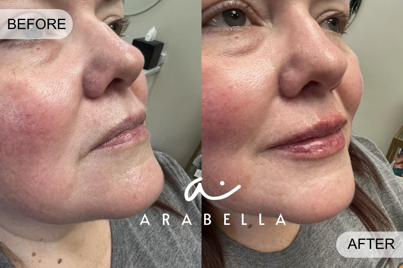 Lip Filler for lips | Before and After Photo | Arabella Medical Aesthetics | Knoxville, TX