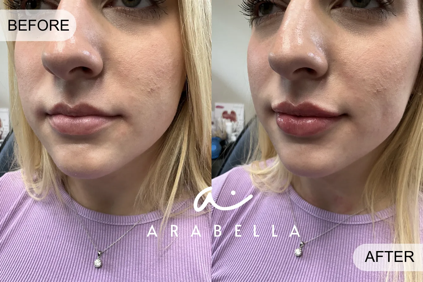 Fuller lips after Lip Filler | Before and After Photo | Arabella Medical Aesthetics | Knoxville, TX