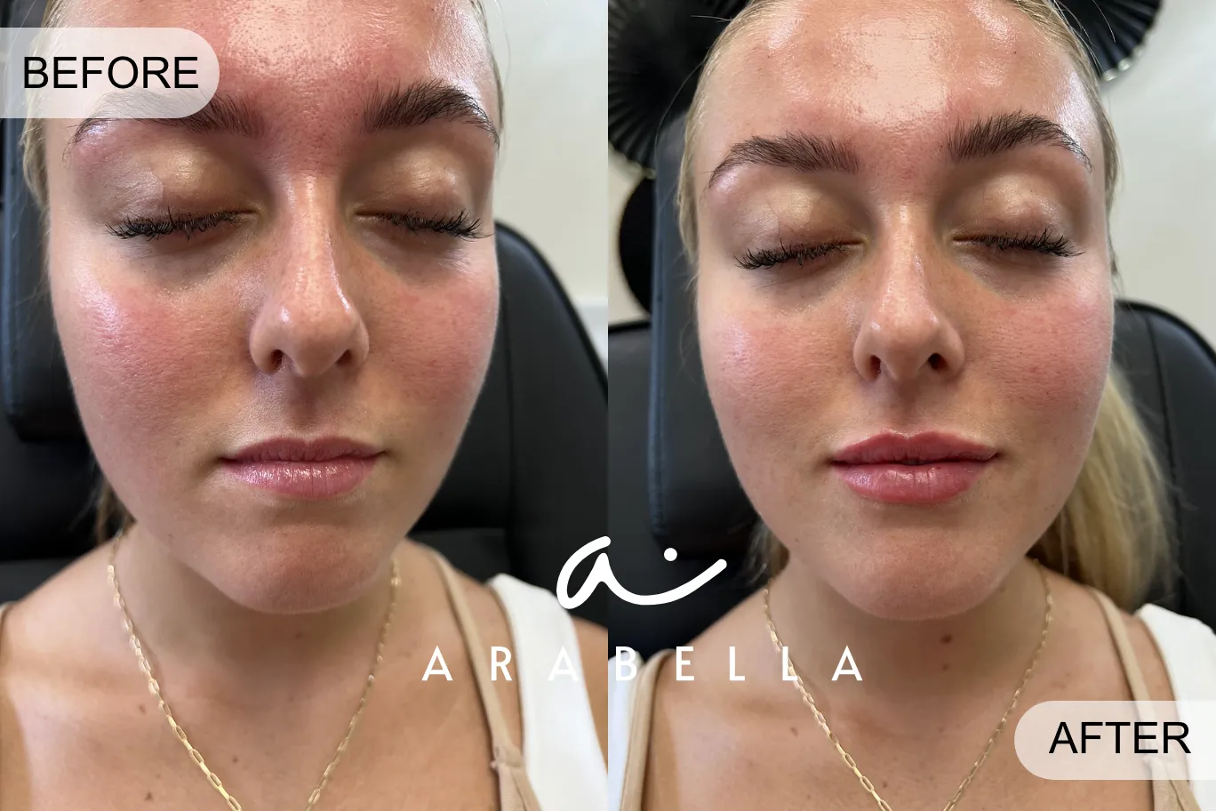 Lip Filler taken by Girl | Before and After Photo | Arabella Medical Aesthetics | Knoxville, TX