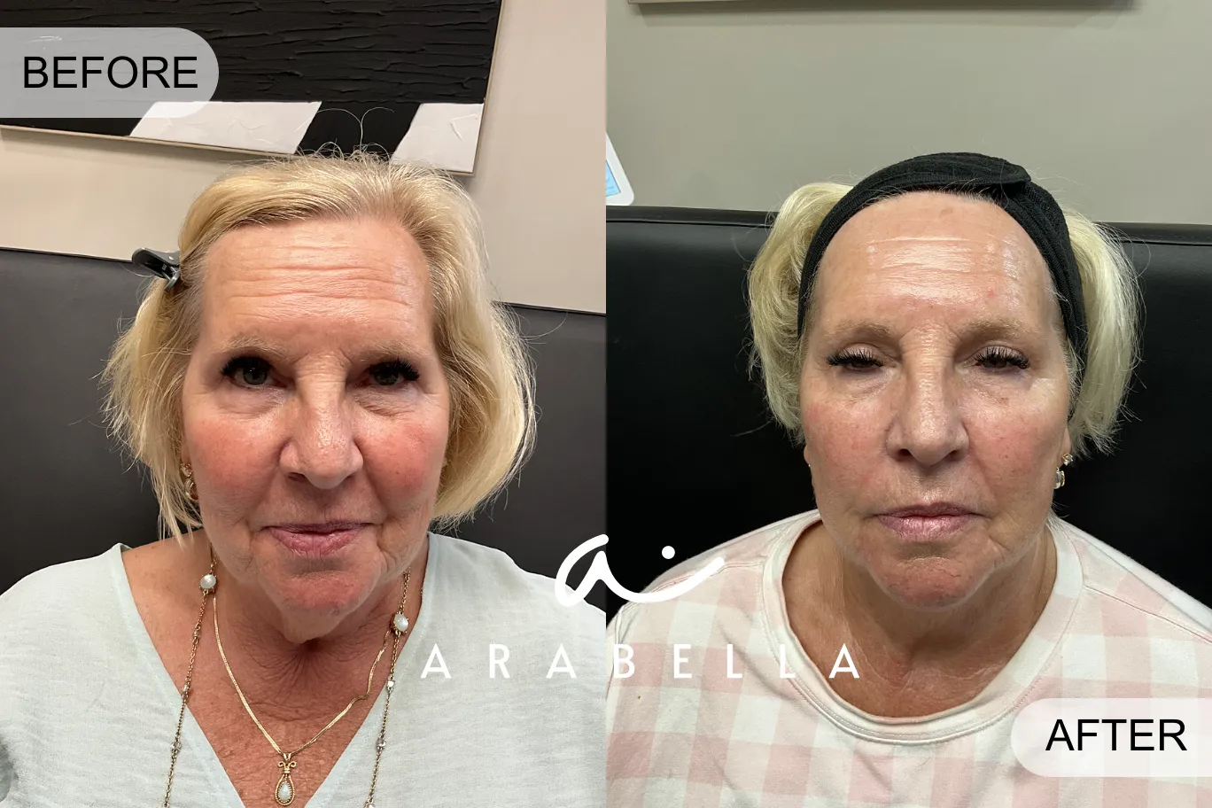 RF Microneedling | Before and After Photo | Arabella Medical Aesthetics | Knoxville, TX