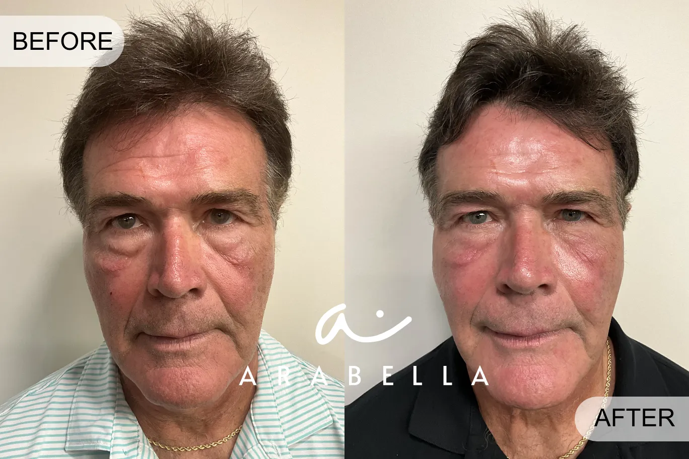 RF Microneedling | Before and After Photo | Arabella Medical Aesthetics | Knoxville, TX