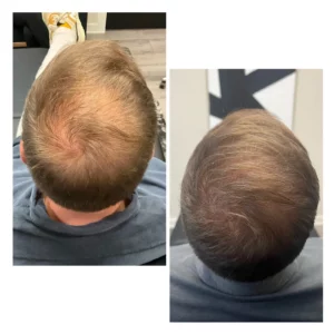 Laser Hair Restoration for Hair Loss Treatment | Arabella Medical Aesthetics | Knoxville, TX